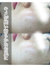 ラエッセ(LAESSE)/ブラックピーリング♪