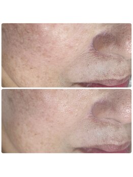 ラウレア(Laule'a)/津山|シミくすみケア