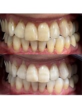 グレイスホワイトニング ヨコハマ(Grace Whitening Yokohama)/40分照射＋水素吸引