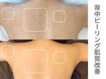 ピュアノア 三木店/背中ピーリング　三木|小野|西脇