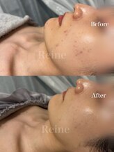 レーヌ(Reine)/白玉ピコジェット