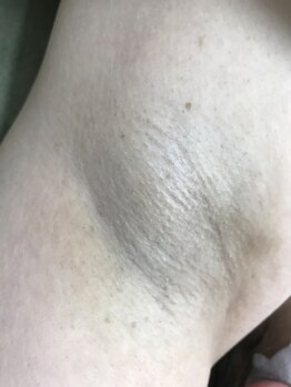 ナノハナ/鹿沼市全身脱毛ナノハナ