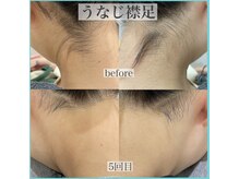 アクト クロ(ACT curro)/【うなじ襟足】脱毛施術例