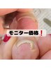 ★モニター価格★巻き爪ケア1本2500円！お試し価格&口コミ投稿でお得