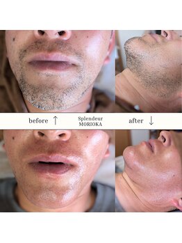 スプランドゥール(Splendeur)/メンズ 髭 ワックス脱毛