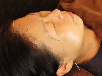 赤坂山王整骨院 鍼灸治療院 阿里山健康センター/美容鍼 むくみ/たるみ/小顔/