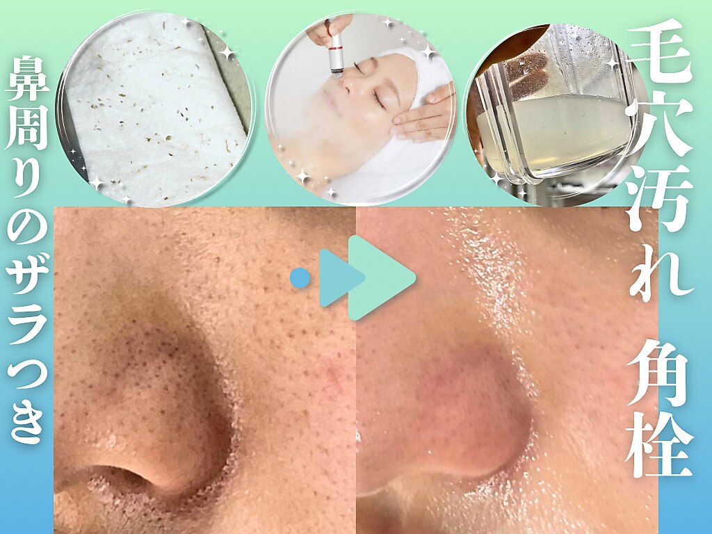 福岡市中央区で毛穴洗浄・毛穴吸引が人気のエステサロン