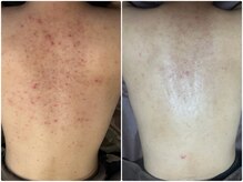 ミラヴィエ(Miravie)/背中ニキビに◎ハーブピーリング