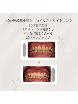 プラスビーセルフ(+b self)/ホワイトニングビフォーアフター