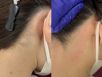 リコ バイ グラス(Rico by GRASS)/うなじ Waxing