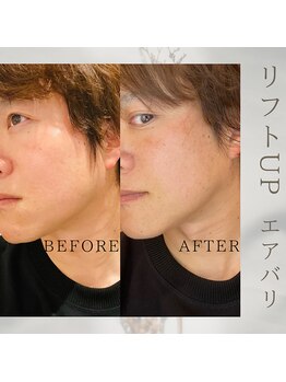 美バリ 新宿店(美BARI)/エアバリ 1回