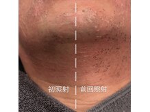 カリス(Charis)/髭脱毛