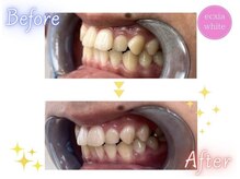 エクシアホワイトニング エミフルMASAKI店/セルフホワイトニング 6カ月後