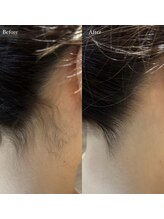 アトリーチェ ベレッツァ(ATTRICE Bellezza)/全身脱毛