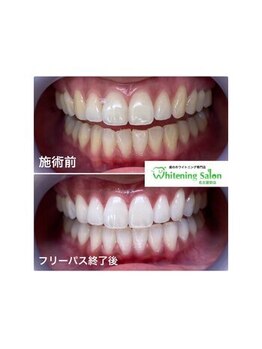 ホワイトニングサロン 名古屋駅店/【ホワイトニング施術例】