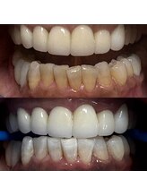 グレイスホワイトニング ヨコハマ(Grace Whitening Yokohama)/40分照射＋水素吸引