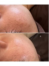 グランデ(Grande)/プラズマニアでシミケア◎