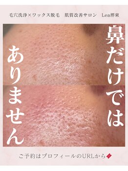 レア(Lea)/頬も汚れは詰まります><