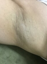 ナノハナ/鹿沼市全身脱毛ナノハナ