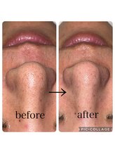 グラシア 宇土店(gracia)/毛穴専門店