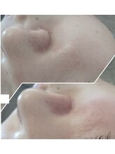 ビーユー(Be.you)/毛穴洗浄