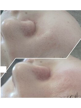 ビーユー(Be.you)/毛穴洗浄