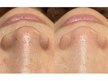 プラチナスタイル(platinum.style)/毛穴洗浄 before after