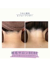 ベベ(Bebe)/うなじ脱毛♪