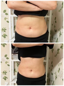 マハロ スコータイ/ビフォーアフター　＜お腹＞