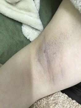 ナノハナ/鹿沼市全身脱毛ナノハナ