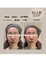 モーイエンチャーム(mooi en charme)/フェイシャル×生ヒト幹50％導入