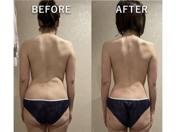 フーシー(FooSee)/痩身エステ ビフォーアフター