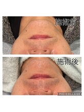 レイモード(Ray mode)/メンズフェイシャルBBL