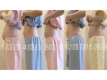 アカシア鍼灸整骨院/【痩身鍼灸モニター】くびれ鍼灸