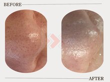 グロウ(glow)/毛穴汚れビフォーアフター