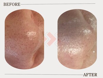 グロウ(glow)/毛穴汚れビフォーアフター