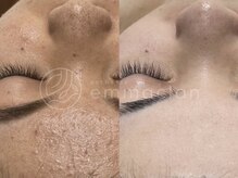 エマクラン(emmaclan)