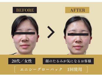 キレイ 筑紫野原田店(KIREI)/20代 肌のたるみが気になる