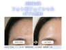 【ダブル照射】フォト光フェイシャル11,000円→5,000円