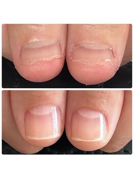 ルミライズ(Lumirise)の写真/【深爪・ちび爪・貝爪…】もう隠さなくて良くなった！との声多数☆希少なネイルケアのみで自爪育成専門店