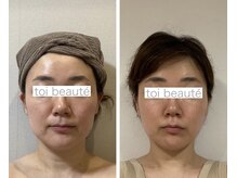 トイボーテ(toi beaute)/小顔矯正&頭蓋骨調整