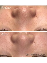 ホワイトワックス 京都四条烏丸(WHITE WAX)/鼻の黒ずみもスッキリ◎
