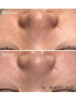 ホワイトワックス 京都四条烏丸(WHITE WAX)/鼻の黒ずみもスッキリ◎