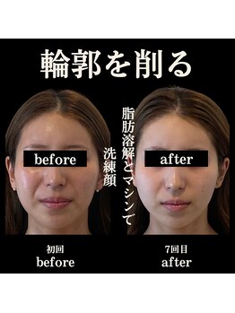 クリニカルボーテ 心斎橋院(CLINICAL BEAUTE)/本気の短期集中！結果が別人級！
