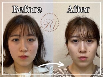 R-1ビューティーサロン 銀座/BEFORE＆AFTER　