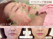 ネテマテ 表参道(netemate)/美容鍼/レモンボトル