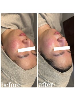 ディオーネ 春日井勝川店(Dione)/ヒト幹細胞毛穴洗浄