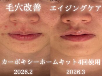 アールエーサロン 恵比寿 広尾(Ra salon)/ニキビ・跡に驚きの変化