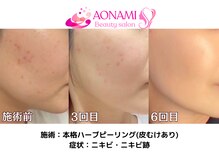 あおなみ はり きゅう整骨院/ハーブピーリング：ニキビ