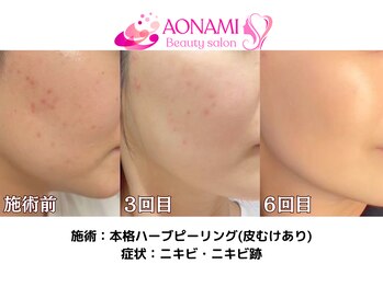 あおなみ はり きゅう整骨院/ハーブピーリング:ニキビ